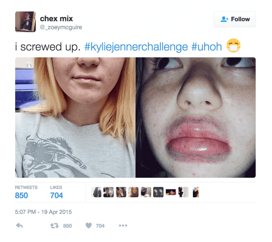 Name: Kylie Jenner Lip Challenge Description: Put a shot glass over your mouth, suck in air, then release. Mimics the lip injections by Kylie Jenner. Warning: Growing Social Media does not recommend this challenge. Hashtag: #KylieJennerChallenge Peak: April 2015